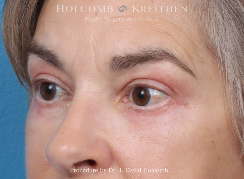 Blepharoplasty Before & After Gallery - Patient 197904 - Image 6