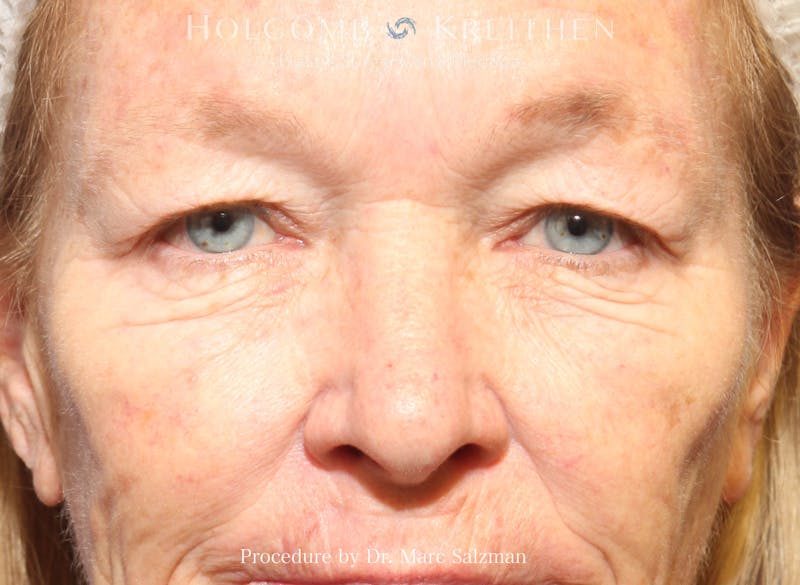 Blepharoplasty Before & After Gallery - Patient 117350 - Image 1