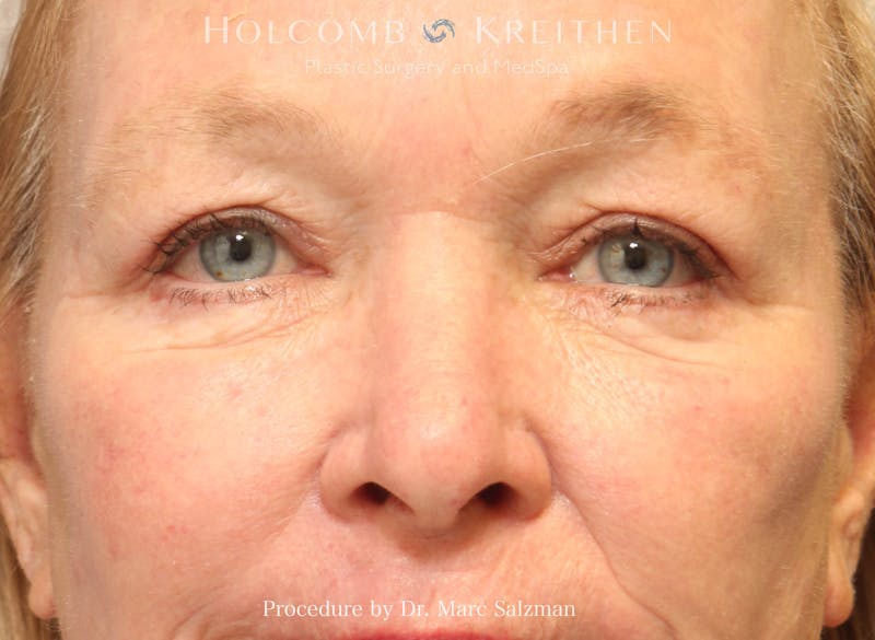 Blepharoplasty Before & After Gallery - Patient 117350 - Image 2