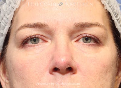 Blepharoplasty Before & After Gallery - Patient 894671 - Image 1