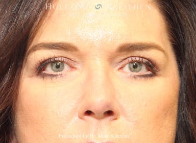 Blepharoplasty Before & After Gallery - Patient 894671 - Image 2