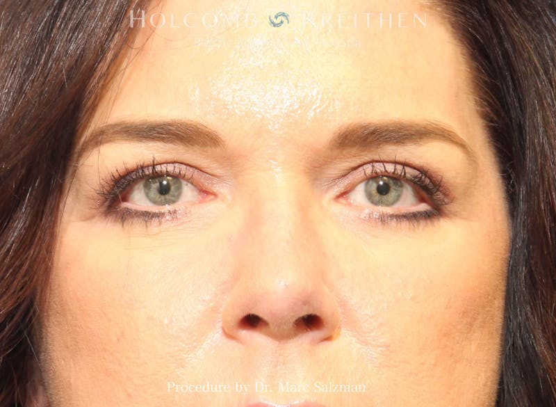 Blepharoplasty Before & After Gallery - Patient 894671 - Image 2