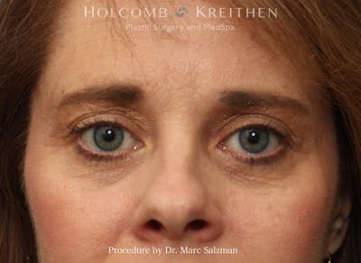 Blepharoplasty Before & After Gallery - Patient 406328 - Image 1