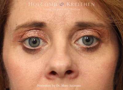 Blepharoplasty Before & After Gallery - Patient 406328 - Image 2