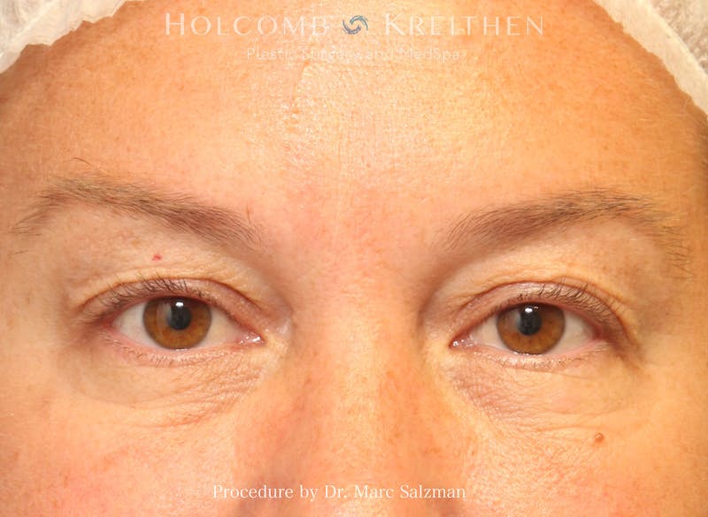 Blepharoplasty Before & After Gallery - Patient 258245 - Image 1