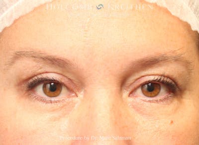 Blepharoplasty Before & After Gallery - Patient 258245 - Image 2