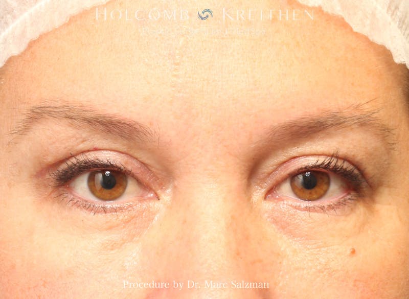 Blepharoplasty Before & After Gallery - Patient 258245 - Image 2