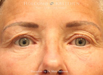Blepharoplasty Before & After Gallery - Patient 427530 - Image 1