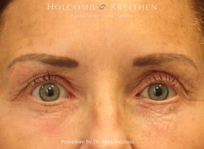Blepharoplasty Before & After Gallery - Patient 427530 - Image 2