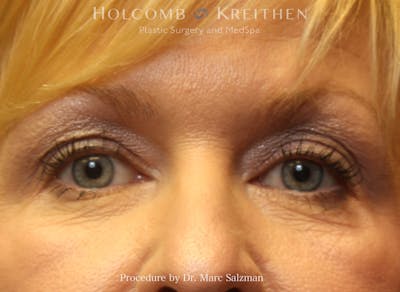 Blepharoplasty Before & After Gallery - Patient 265528 - Image 1