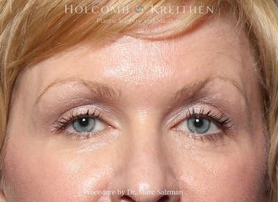 Blepharoplasty Before & After Gallery - Patient 265528 - Image 2