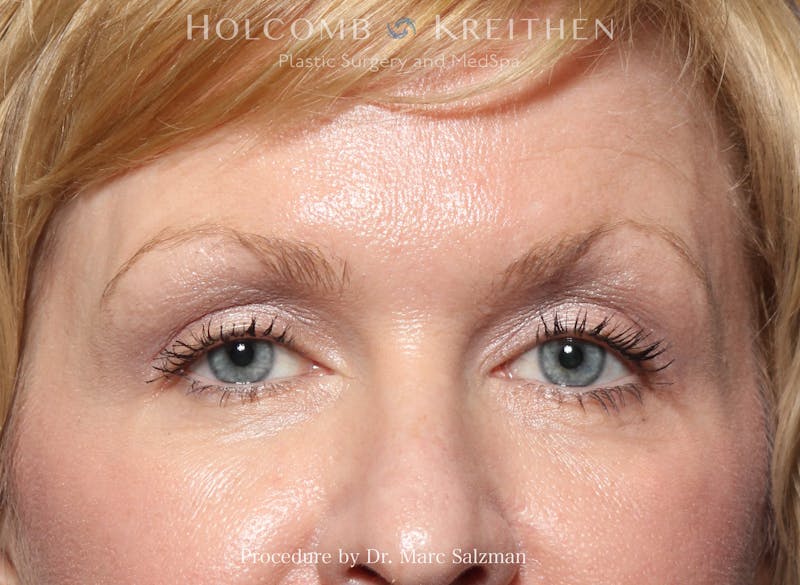 Blepharoplasty Before & After Gallery - Patient 265528 - Image 2