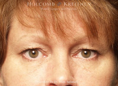 Blepharoplasty Before & After Gallery - Patient 412115 - Image 1
