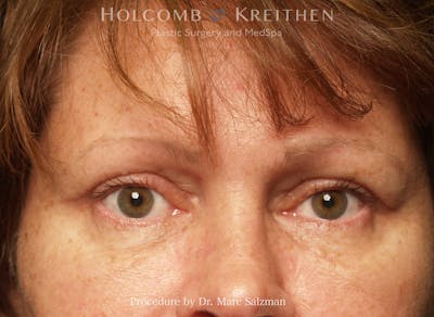 Blepharoplasty Before & After Gallery - Patient 412115 - Image 2