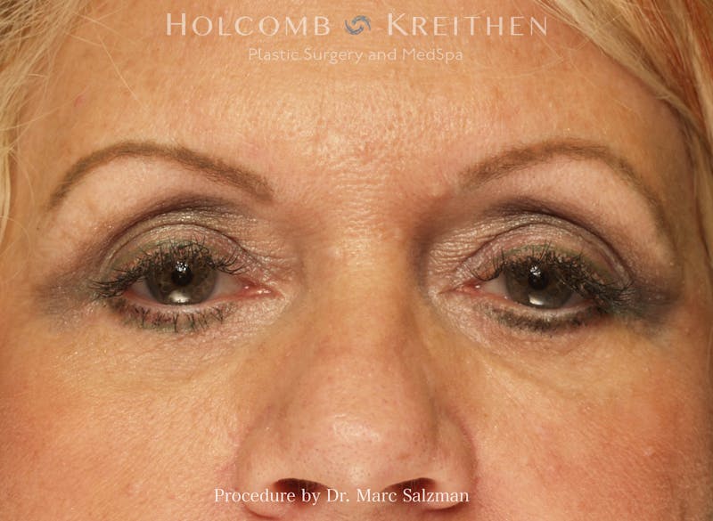 Blepharoplasty Before & After Gallery - Patient 283436 - Image 1