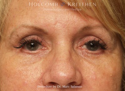 Blepharoplasty Before & After Gallery - Patient 283436 - Image 2