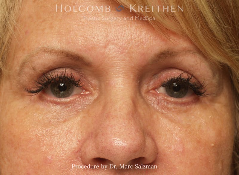 Blepharoplasty Before & After Gallery - Patient 283436 - Image 2