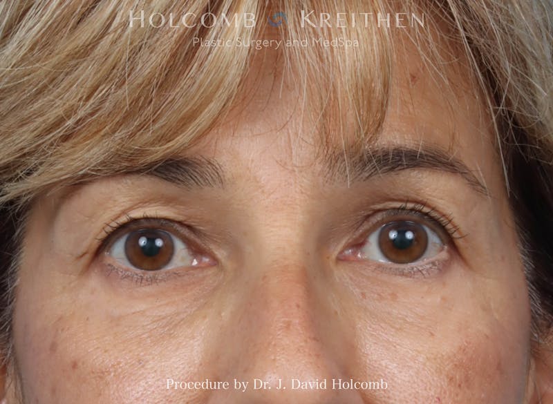 Blepharoplasty Before & After Gallery - Patient 265967 - Image 1