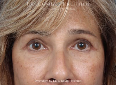 Blepharoplasty Before & After Gallery - Patient 265967 - Image 2