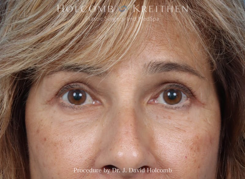 Blepharoplasty Before & After Gallery - Patient 265967 - Image 2