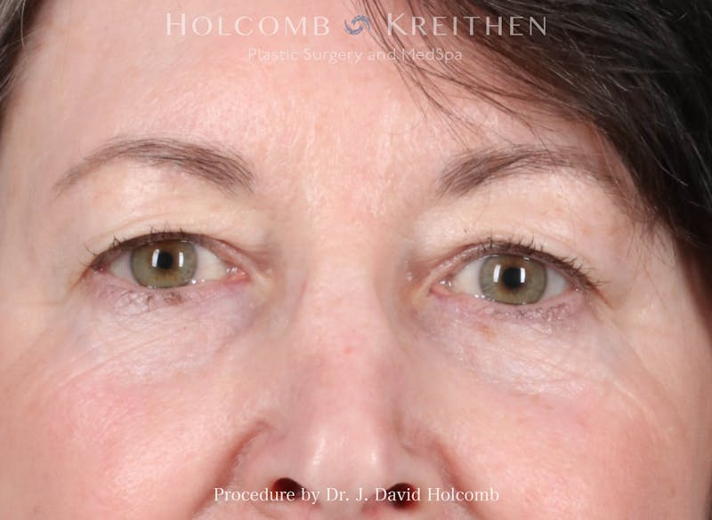 Blepharoplasty Before & After Gallery - Patient 241552 - Image 1