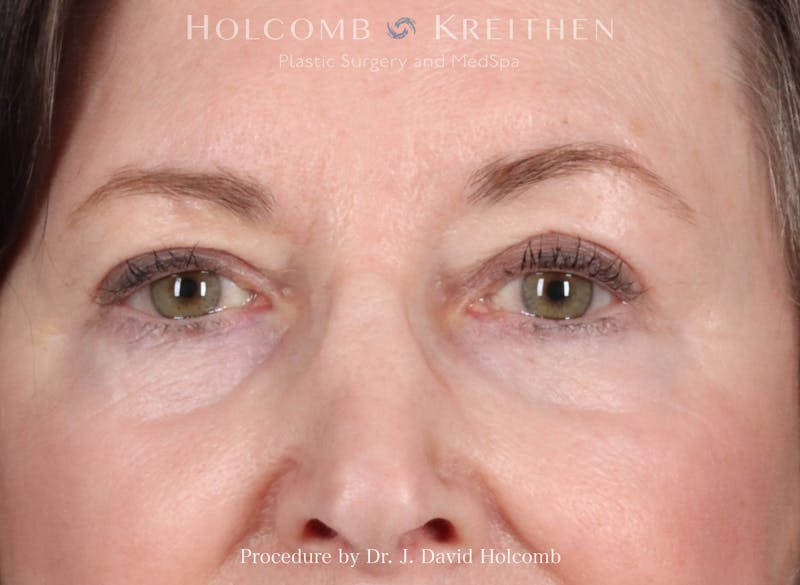 Blepharoplasty Before & After Gallery - Patient 241552 - Image 2