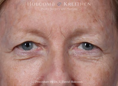 Blepharoplasty Before & After Gallery - Patient 122837 - Image 1