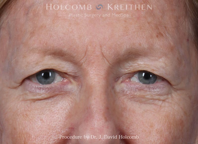 Blepharoplasty Before & After Gallery - Patient 122837 - Image 1