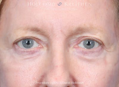 Blepharoplasty Before & After Gallery - Patient 122837 - Image 2