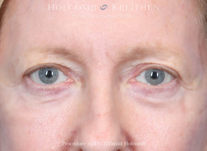 Blepharoplasty Before & After Gallery - Patient 122837 - Image 2