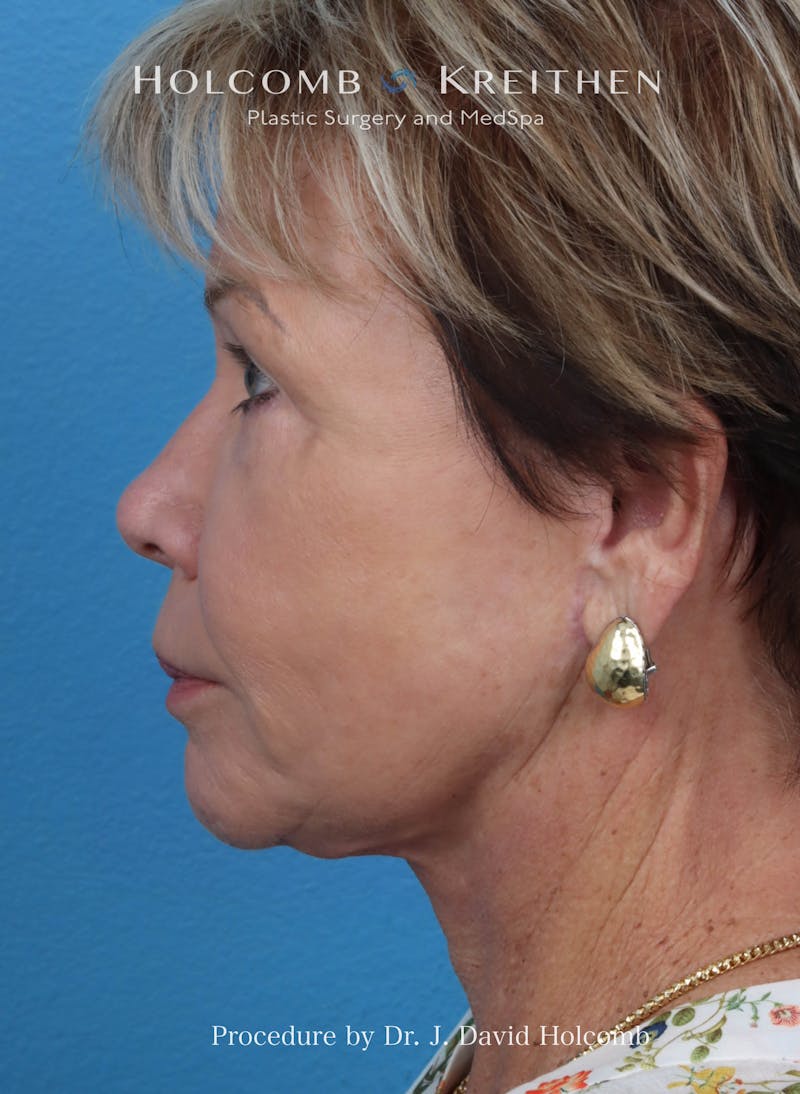 Facelift Before & After Gallery - Patient 409180 - Image 4