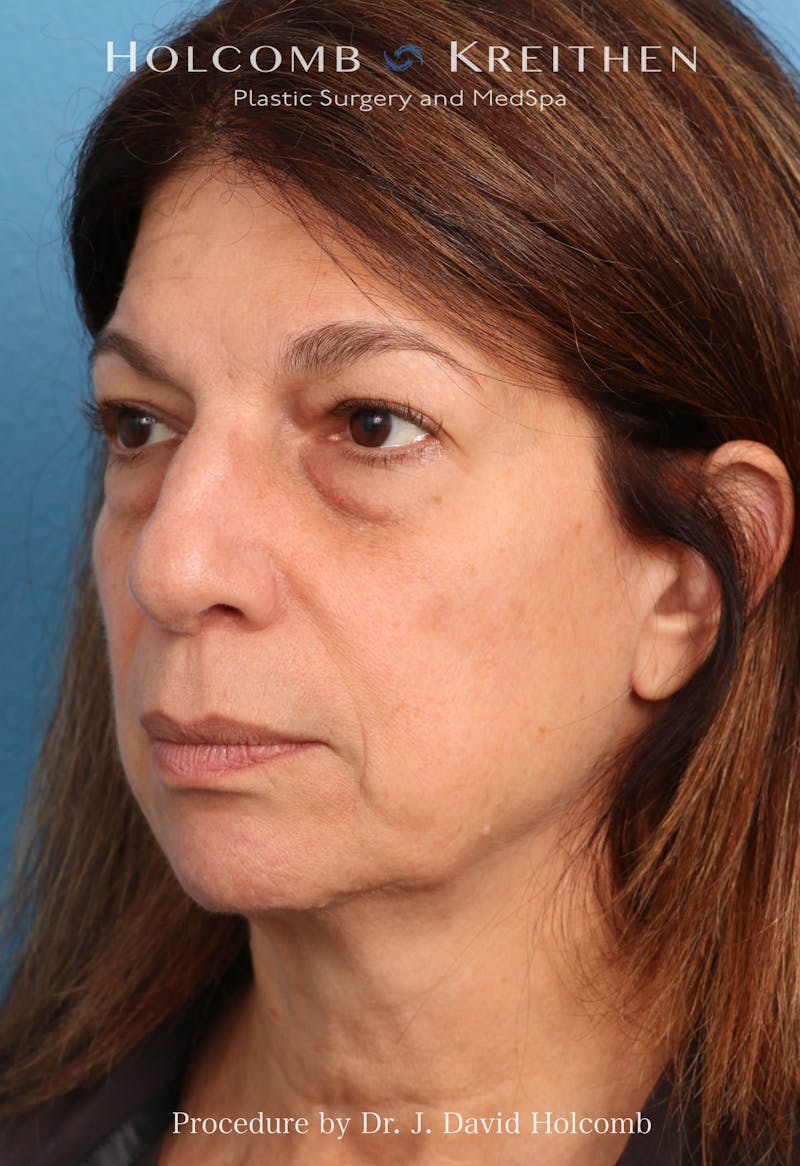 Facelift Before & After Gallery - Patient 129943 - Image 1