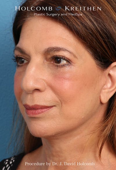 Facelift Before & After Gallery - Patient 129943 - Image 2