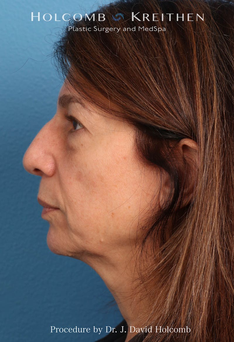 Facelift Before & After Gallery - Patient 129943 - Image 3