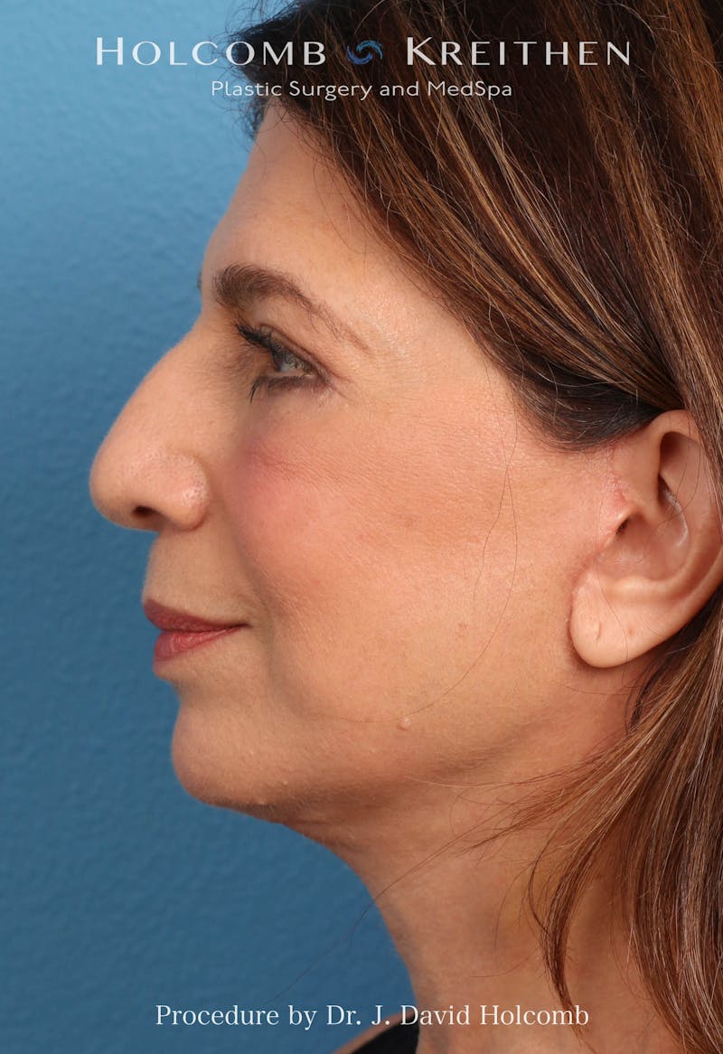 Facelift Before & After Gallery - Patient 129943 - Image 4
