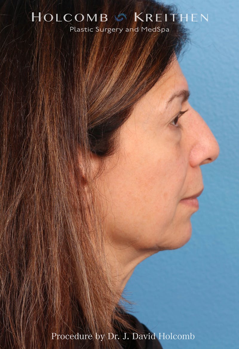 Facelift Before & After Gallery - Patient 129943 - Image 5