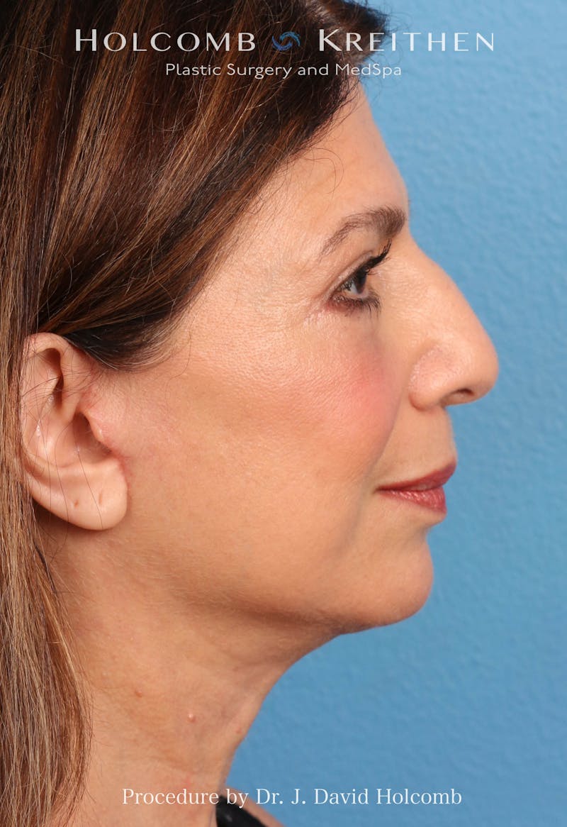 Facelift Before & After Gallery - Patient 129943 - Image 6