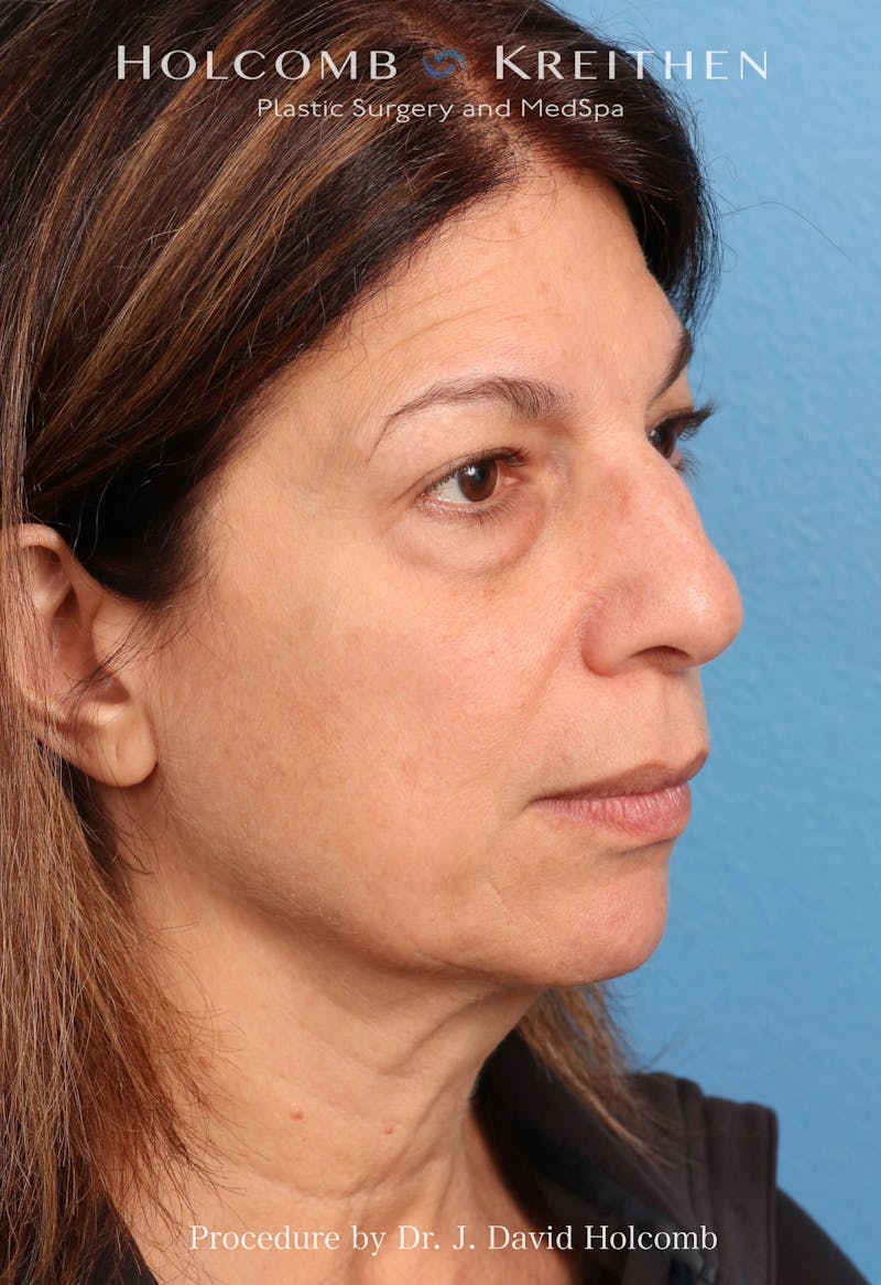 Facelift Before & After Gallery - Patient 129943 - Image 7