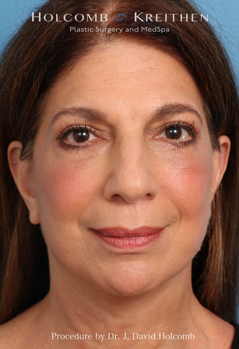 Facelift Before & After Gallery - Patient 129943 - Image 9