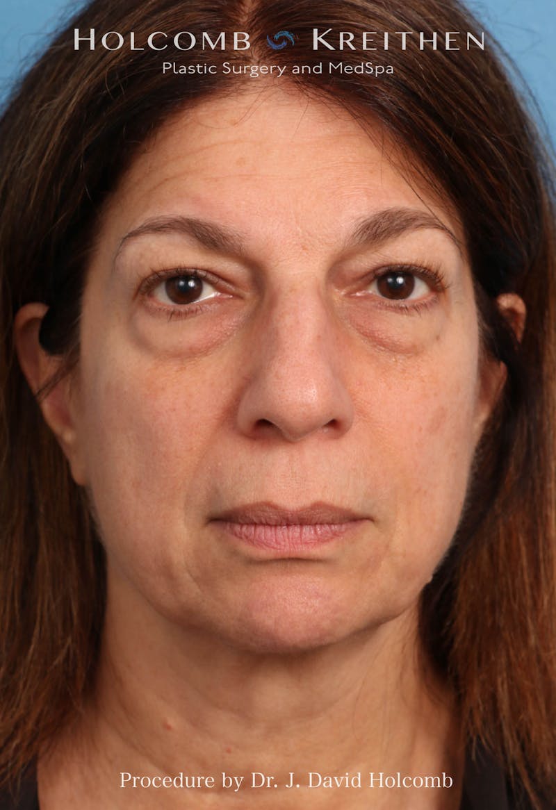 Facelift Before & After Gallery - Patient 129943 - Image 10