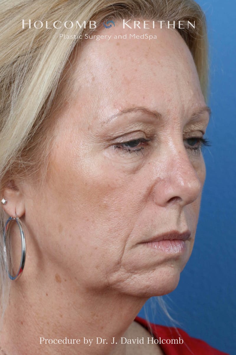 Facelift Before & After Gallery - Patient 288568 - Image 1