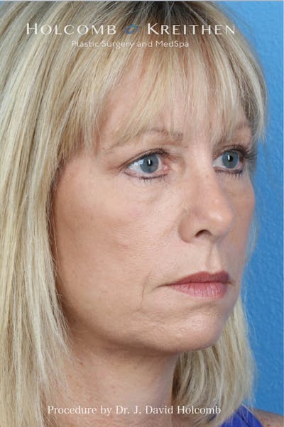 Facelift Before & After Gallery - Patient 288568 - Image 2