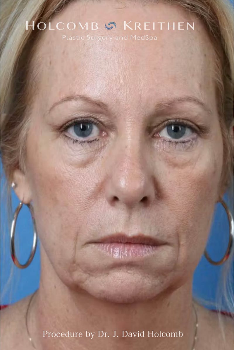 Facelift Before & After Gallery - Patient 288568 - Image 5