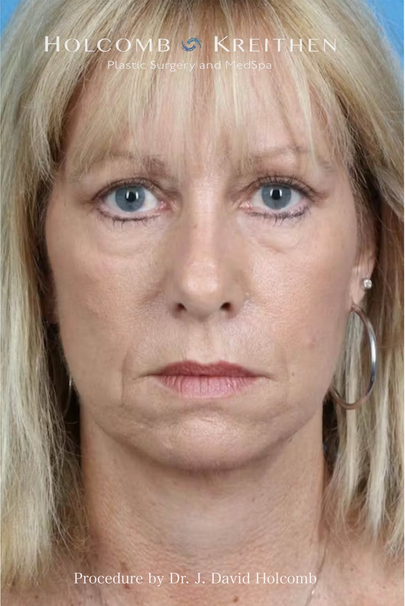 Facelift Before & After Gallery - Patient 288568 - Image 6