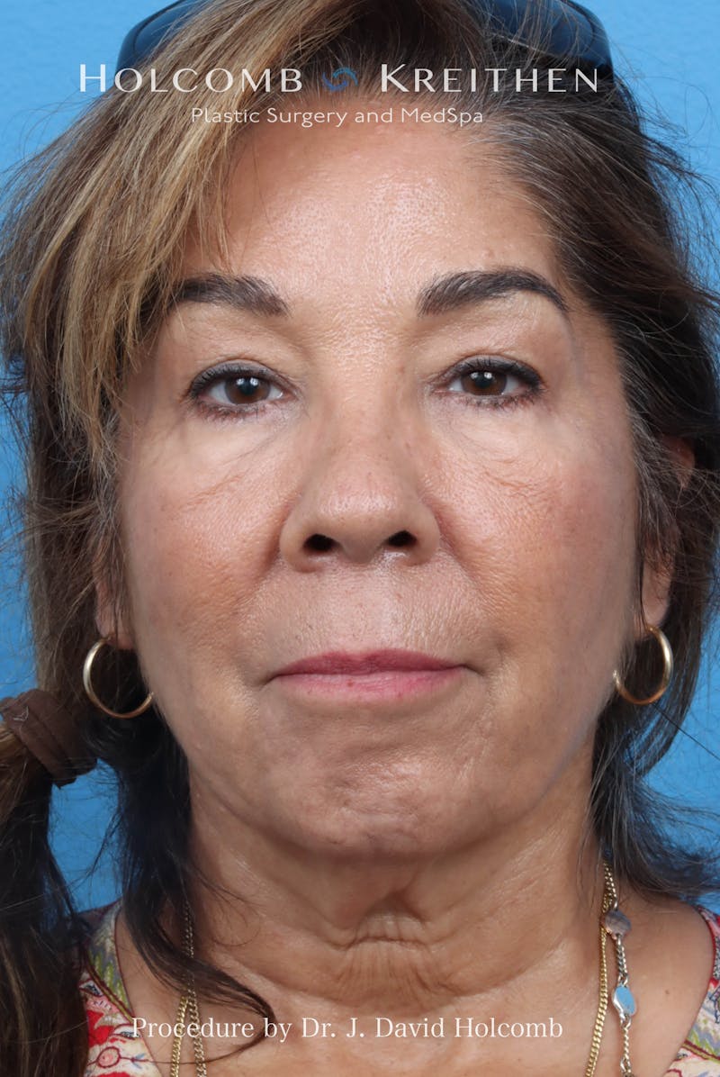 Facelift Before & After Gallery - Patient 124002 - Image 1