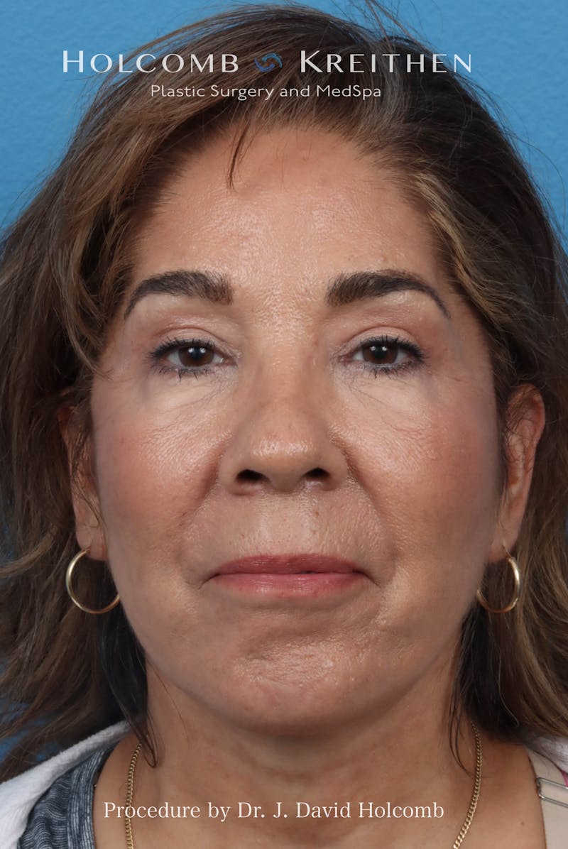 Facelift Before & After Gallery - Patient 124002 - Image 2