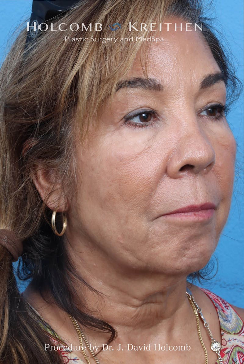 Facelift Before & After Gallery - Patient 124002 - Image 3