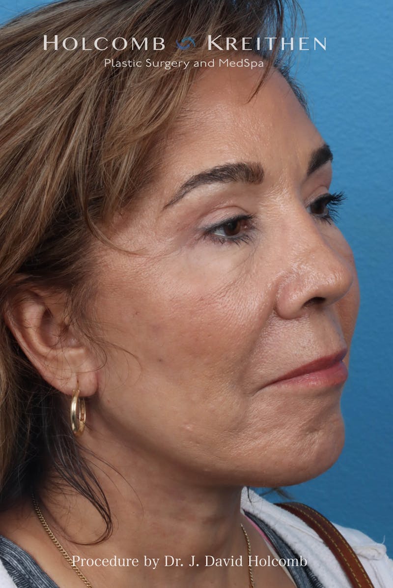 Facelift Before & After Gallery - Patient 124002 - Image 4