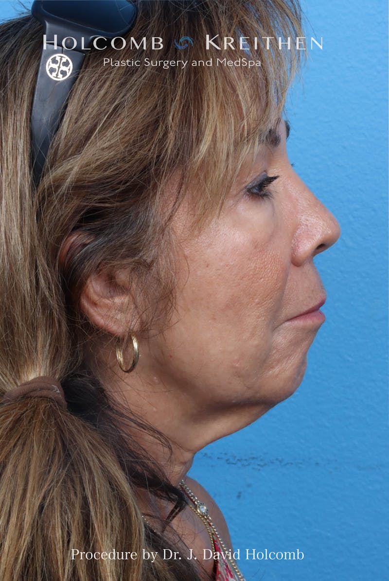 Facelift Before & After Gallery - Patient 124002 - Image 5