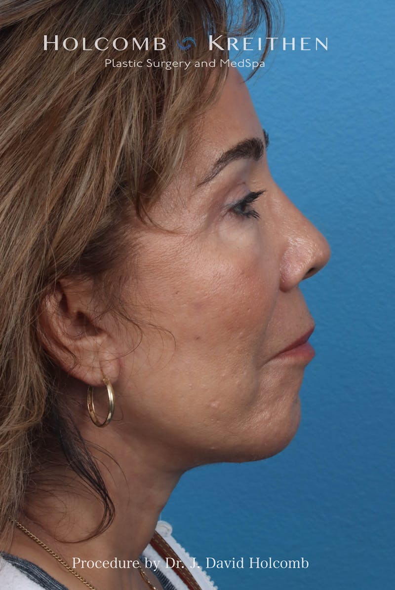 Facelift Before & After Gallery - Patient 124002 - Image 6
